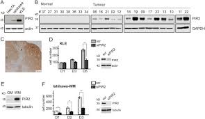 The ultrasound tech did not see the cancer in the uterus and i didn't have a uterine biopsy like it sounds you have. Pir2 Rnf144b Is A Potential Endometrial Cancer Biomarker That Promotes Cell Proliferation Cell Death Disease