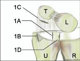 Palmer classification of tfcc pathologies • in 1989, palmer proposed a classification system for tfcc lesions. Palmer Classification Of Tfcc Traumatic Injuries A Vertical Tear 2 Download Scientific Diagram