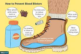 Definitions by the largest idiom dictionary. Blood Blisters An Overview