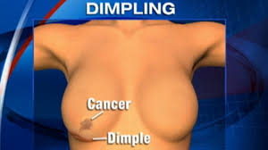 The skin around it may look thicker, red, or bruised. Dimpling Skin Could Be A Sign Of Breast Cancer Video Abc News