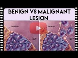 Feeling or showing ill will or hatred. Medical Coding Basics Benign Vs Malignant Lesion Youtube