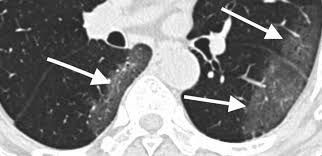 Your doctor or the imaging facility will let you know if your exam will require contrast dye. Coronavirus Patient Ct Scans Reveal Imaging Features