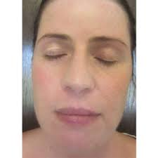 BBL™ Photofacial Before and Afters
