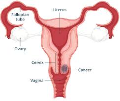 Image result for Cervical Cancer
