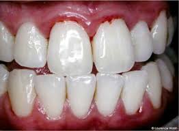 Gingivitis is a common but mild form of gum disease, the first sign of which is often bleeding gums. Swollen Gums