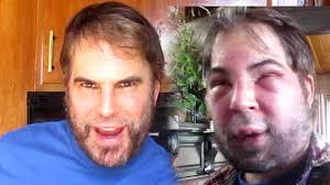 I Am Unrecognizable Minutes After Getting Injection