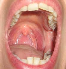 Image result for Strep throat infection roof of mouth