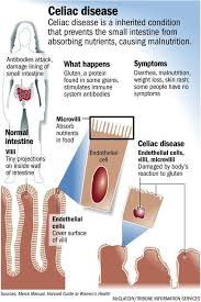 Some People Actually Gain Weight With Celiac This Is Due To Malabsorption Causi Celiac Disease Celiac What Is Celiac