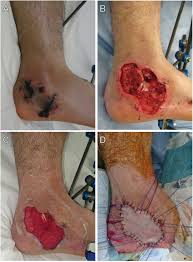 This can be from injury, radiation, or chemicals. Treatment Of The Open Wound On The Heel A Skin Necrosis Had Occurred Download Scientific Diagram