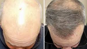 Doctor Live ما هو أفضل مركز لزراعة الشعر بتركيا 2021
