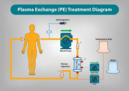Image result for Apheresis