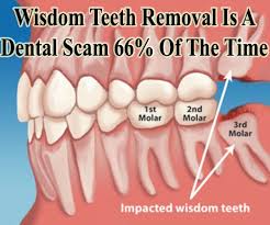 Though Many People Want To Remove Their Isdom Teeth There Are Research That Says Wisdom Teeth Is He Impacted Wisdom Teeth Wisdom Teeth Wisdom Tooth Extraction