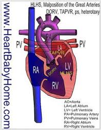 35 Hypoplastic Left Heart Syndrome Hlhs Ideas Heart Defect Syndrome Congenital Heart