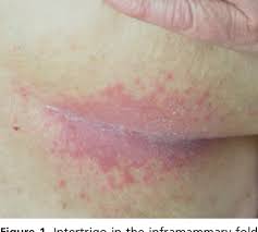 Intertrigo is a sign of inflammation or infection. Pdf Intertrigo And Common Secondary Skin Infections Semantic Scholar