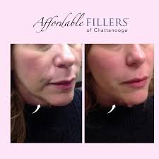 Beware the 'witch's chin! Get Smoother jawlines with one syringe with Nurse  Jill at Affordable Fillers of Chattanooga