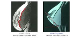 Jun 09, 2021 · 대표적인 가슴 성형수술 부작용에는 구형구축과 보형물 파손, 리플링(보형물 윤곽이 보이는 현상) 등이 있으며, 불만족 사례의 경우 모양이나 대칭, 크기에 대한 것들이 많다. Mediment