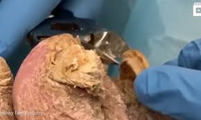 However, since the nail has pierced the skin and is lodged inside it like a knife, the healing process cannot happen. Stomach Churning Footage Captures A Podiatrist Cutting Patient S Thick Toenails Daily Mail Online