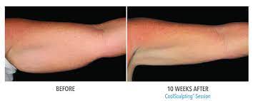 Coolsculpting + upper arms q&a. Coolsculpting Before And After Ultra Smooth Skin Scottsdale Chandler Az
