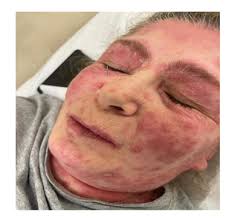 Severe Generalized Sweet Syndrome with good outcome: A Case Report