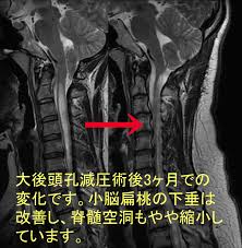 空洞空洞 (kūdō kūdō) (english translation). å„ç–¾æ‚£èª¬æ˜Ž è‡¨åºŠã«ã¤ã„ã¦ æ»‹è³€åŒ»ç§'å¤§å­¦ è„³ç¥žçµŒå¤–ç§'å­¦è¬›åº§