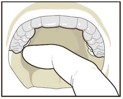 How to clean my plastic retainer. Wear And Care Instructions For Clear Retainers Premier Orthodontics