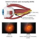 Optic Neuropathy: Symptoms, Causes & Treatment | Kraff Eye Institute