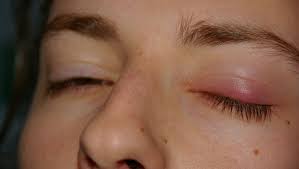 как лечить ячмень на нижнем веке в домашних условиях Kak Lechit Halyazion