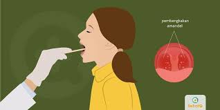 Radang Amandel Dapat Disembuhkan Dengan Beristirahat Konsumsi Antibiotik Atau Operasi Jika Diperlukan Radang Amandel Adalah Penyakit Tanda Sakit Tenggorokan