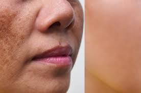Image result for Melasma calycinum