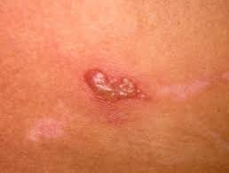 The prodrome is a phase of signs or symptoms that indicates the onset of an outbreak. Herpes Simplex Dermnet Nz
