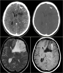 The Radiology Assistant Systematic Approach In 2020 Brain Tumor Radiology Imaging Brain Images
