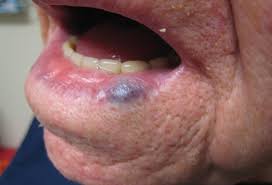 These benign lesions form when blood vessels, called venules, dilate. Cherry Angioma Picture Image On Medicinenet Com