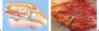 The medial femoral condyles are also distinguished by another anatomical term of location. A Vascular Anatomy Of The Medial Femoral Condyle Periosteal Flap The Download Scientific Diagram