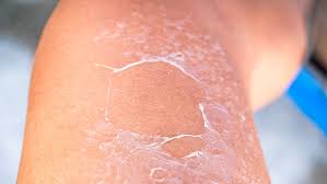 See full list on wikihow.com What To Do When Your Face Is Peeling What To Do When Your Skin Is Peeling Shefinds