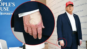 Trump, 79, Smears Right Hand in Makeup Amid Cankles Cover-Up