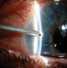 Image result for Eye Foreign Body
