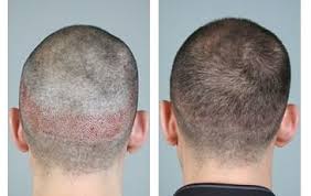 Before and after pictures never show guys with long hair. Does The Hair In The Donor Area Grow Back After It Has Been Removed Cyber Hairsure