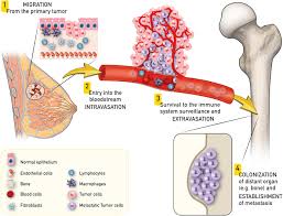 For more than half of women who develop stage iv breast cancer, the bones are the first site of metastasis. Frontiers Innovative Options For Bone Metastasis Treatment An Extensive Analysis On Biomaterials Based Strategies For Orthopedic Surgeons Bioengineering And Biotechnology