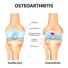 Osteoarthritis Treatment In Ayurveda Osteoarthritis Treatment In Kerala