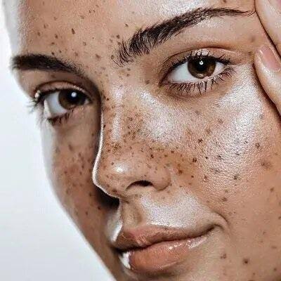 Best Pigmentation Treatment in Dubai & Abu Dhabi | HyperPigmentation