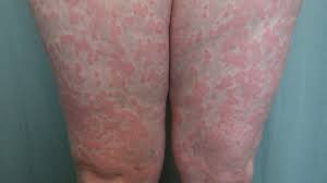Well, aside from the proper treatment to care for the issue, it is also important to understand the. Hot Tub Rash Cure Medical Home Remedies Hot Tub Rash Pictures