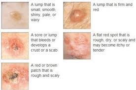 The main types of skin cancer are basal cell carcinoma (bcc), squamous cell carcinoma (scc), melanoma. Skin Cancer Symptoms