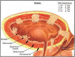 Image result for Bladder Cancer