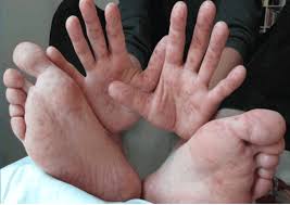 Hand Foot And Mouth Disease What It Is How To Treat It