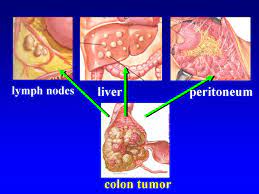 This would mean having surgery to remove the section of the colon containing the cancer along with nearby lymph nodes, plus surgery to remove the areas of cancer spread. Hipec Ovhipec Pmp Peritoneal Cancer Peritoneum Seeding Seedings Metastases Hyperthermic Intraperitoneal Chemotherapy Debulking Colon Colorectal Ovarian Ovary Mesothelioma Pseudomyxoma Appendix