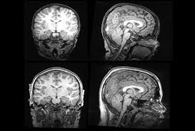 Thinking across the spectrum as want to read Big Brain May Mark Subtype Of Autism Spectrum Autism Research News