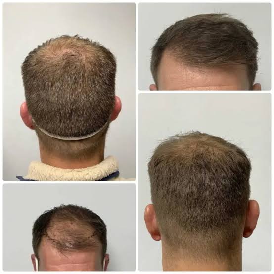 Are you a good candidate for hair transplant surgery? - Dr Bonaros