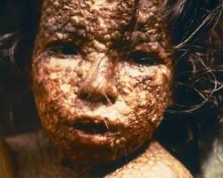 Image of smallpox history