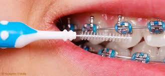 Wann ist es an der zeit, sich eine zahnspange zuzulegen? Zahnpflege Bei Kindern Mit Zahnspangen Blog Zahnputzladen