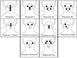 Figure 1 From The Effect Of Surface Electrical Stimulation